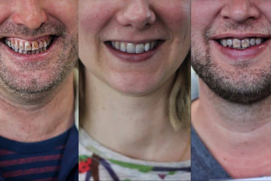 Teeth Whitening for Men: 14 Methods That ACTUALLY Work ...