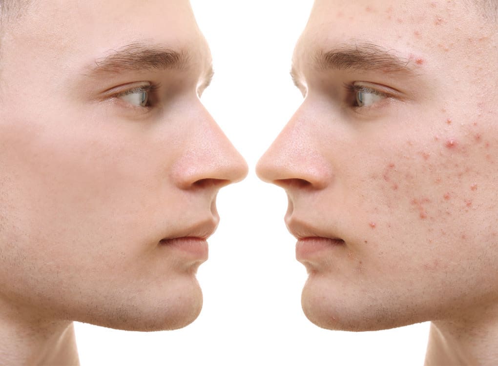 men and acne