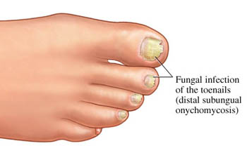 men's toe fungus grooming