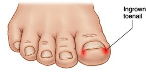 ingrown nail